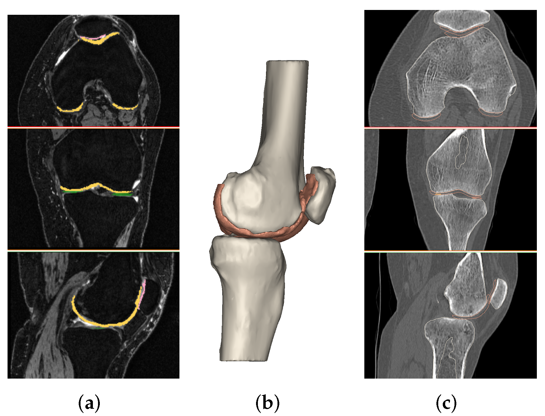 Perspectiva de un paciente con osteoartrosis de rodilla