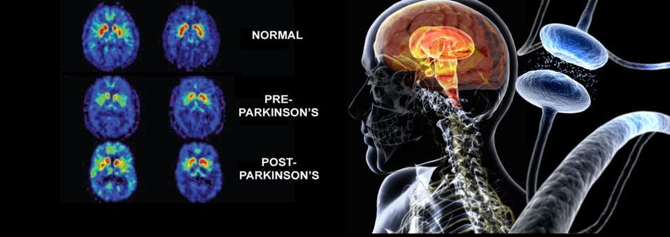 Enfermedad de Parkinson y ejercicio, ¿Cuáles son los potenciales beneficios?