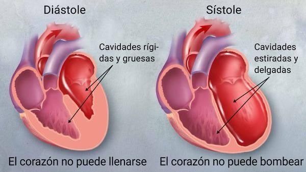 Insuficiencia cardíaca avanzada: entendiendo la condición y su manejo
