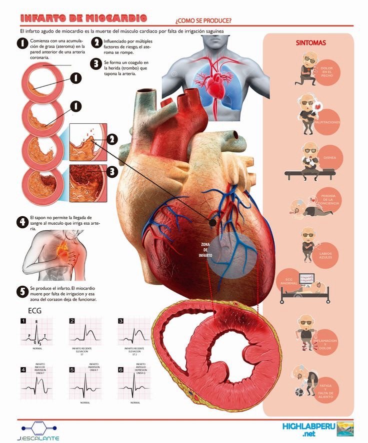 Diagnóstico y manifestaciones coincidas del Shock Cardiogénico Post-Infarto de miocardio: resumen