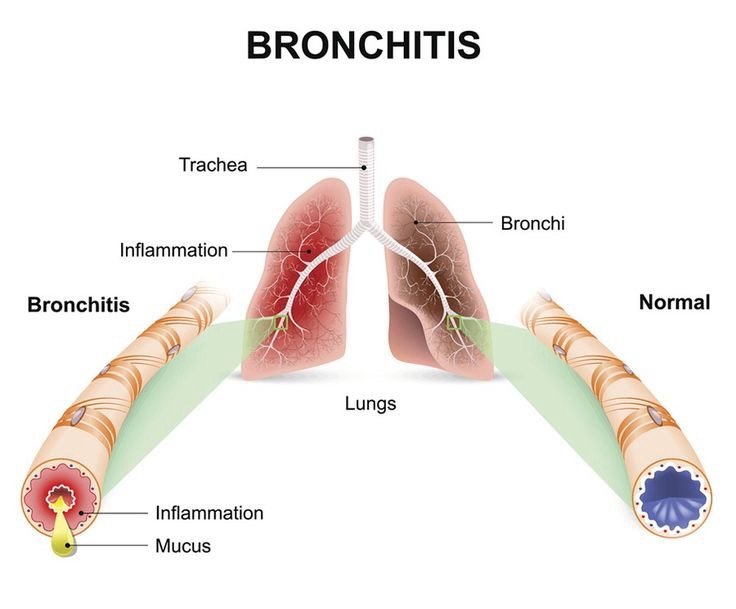 Bronquitis Aguda: Comprendiendo la Inflamación de los Bronquios